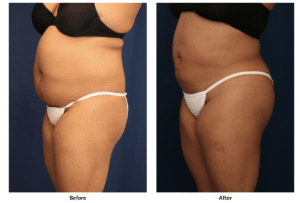 Before and after photos of a woman who received liposuction at Dr. Ronald Schuster's office